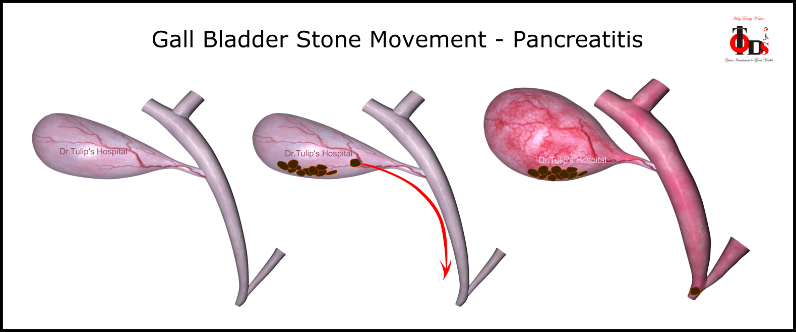 GB Stone movement - Pancreatitis